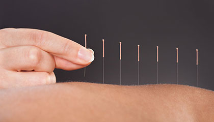 Acupuncture