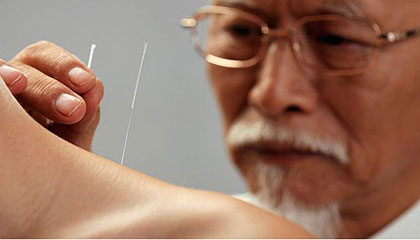 Acupuncture